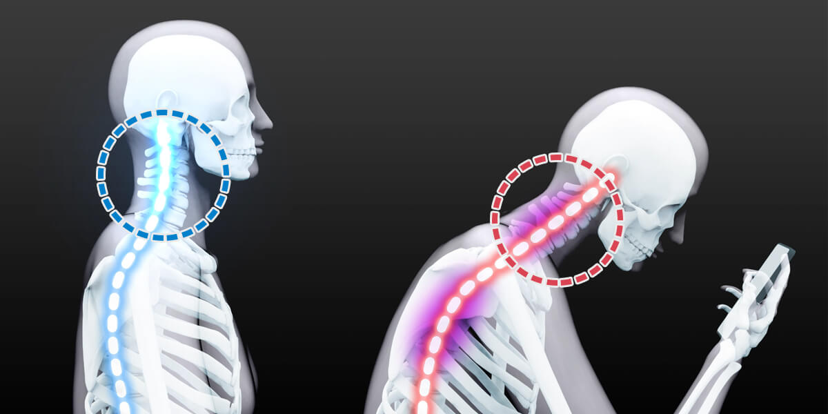 ストレートネックとは？